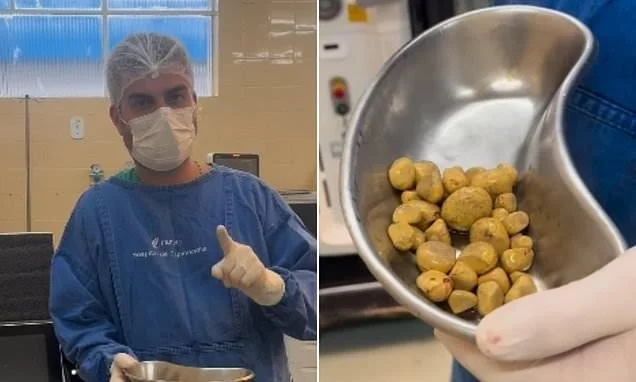 Doctor warns of kidney stones after man drinks 3 liters of soda daily