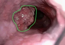 Uganda faces a rise in esophageal cancer cases, experts call for early action.webp