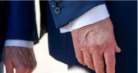 Trump's swollen legs force White House health admission.webp