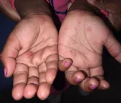 Bulawayo issues alert over suspected HFMD cases.webp