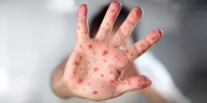 Measles outbreaks surge, delayed data hides true spread.webp